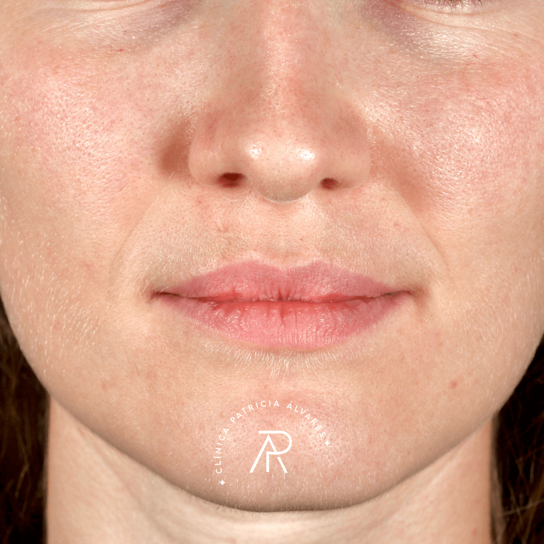 imgi_19_labios-antes