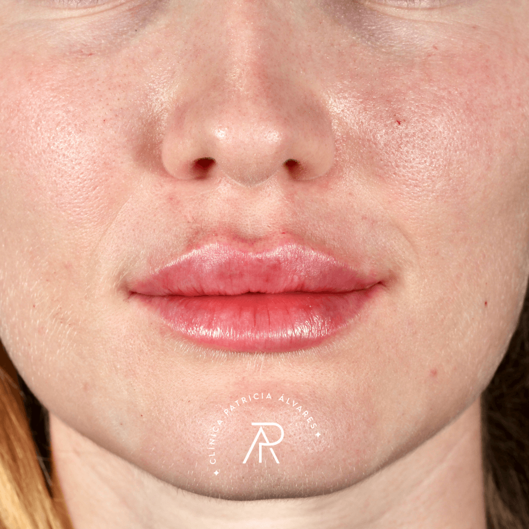 imgi_20_labios-depois